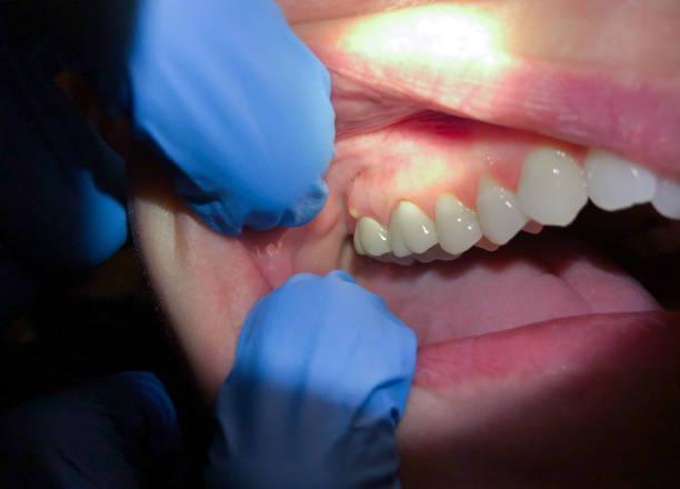 Best Emergency Treatment for Dental Infections or Abscesses in Clendenin, WV
